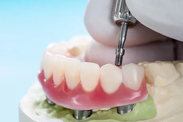 Dental Implants