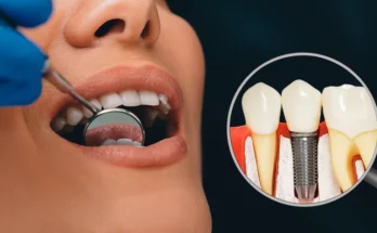 Dental Implants