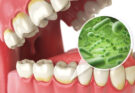 Chula Vista, CA: Causes and Prevention of Tooth Decay