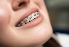 Common Orthodontic Braces Issues That Can Fix At Home